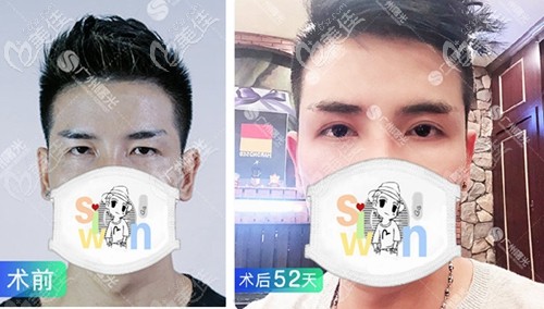 廣州曙光上瞼下垂矯正案例 廣州曙光上瞼下垂矯正案例