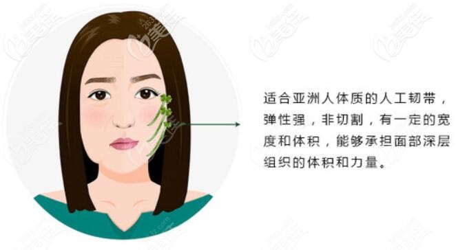 人工韌帶提升面部是怎么操作的 人工韌帶提升面部是怎么操作的