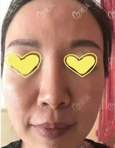 人工韌帶提升面部術(shù)前 人工韌帶提升面部術(shù)前