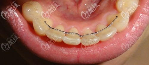 舌側(cè)保持器