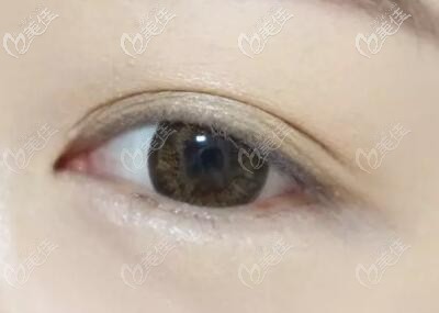 割雙眼皮眼尾處褶皺短點(diǎn)好看還是長點(diǎn)好看呢