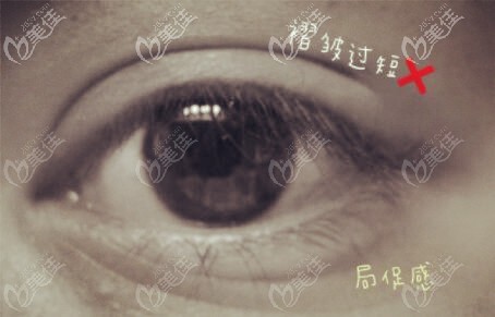 雙眼皮眼尾處褶皺過段的缺點(diǎn)