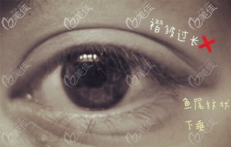 雙眼皮眼尾處褶皺短長的缺點(diǎn)