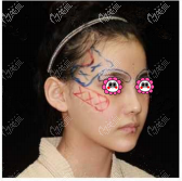 在北京童仁做仿生韌帶填充眉弓前 在北京童仁做仿生韌帶填充眉弓前