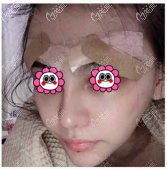 墊眉弓手術(shù)后當天樣子 墊眉弓手術(shù)后當天樣子