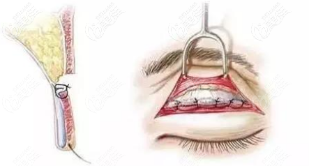 切開雙眼皮形態(tài) 切開雙眼皮形態(tài)