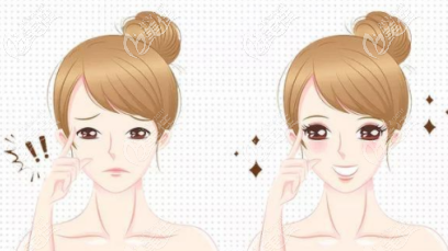 雙眼皮動畫圖示 雙眼皮動畫圖示