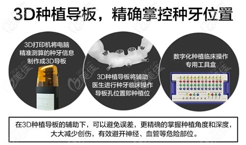 長春超龍牙3D種植牙導(dǎo)板