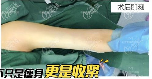 安利手臂吸脂和黃金微雕一起做,看我在洛陽毛大夫做的效果就不錯還沒反彈