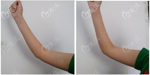 手臂吸脂術(shù)后3個(gè)月效果 手臂吸脂術(shù)后3個(gè)月效果