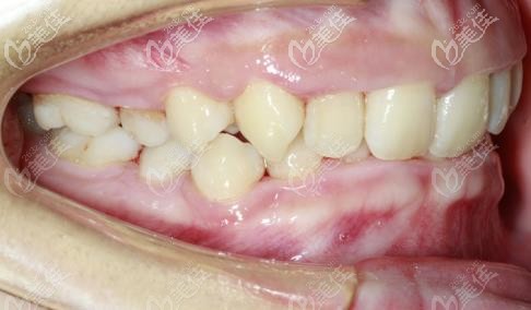 矯正前的牙齒側(cè)面 矯正前的牙齒側(cè)面