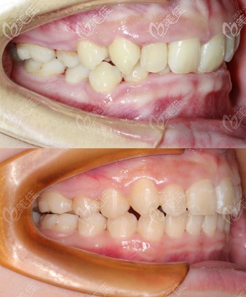 矯正的前后對比 矯正的前后對比
