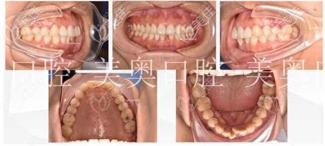 術前牙齒擁擠參差不齊 術前牙齒擁擠參差不齊