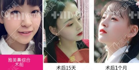 長沙雅美鼻綜合真人前后對比案例照