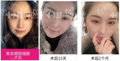 長沙雅美雙眼皮整形真人前后對比案例照