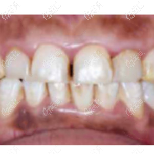 沒有治療前我的氟斑牙和牙縫大 沒有治療前我的氟斑牙和牙縫大