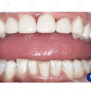 做完全瓷貼面后我的牙齒情況 做完全瓷貼面后我的牙齒情況