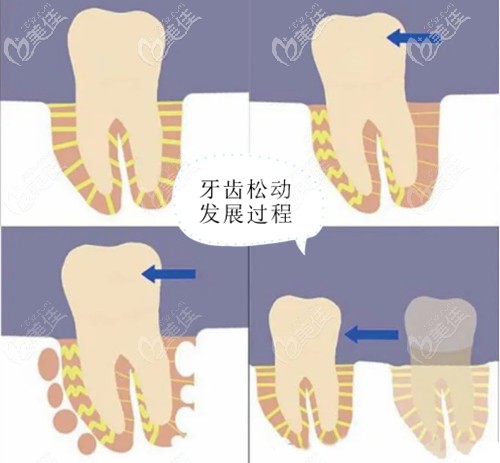牙周炎導(dǎo)致的牙齒松動發(fā)展過程圖 牙周炎導(dǎo)致的牙齒松動發(fā)展過程圖