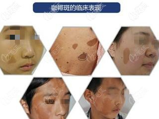 牛奶咖啡斑圖片小孩 牛奶咖啡斑圖片小孩