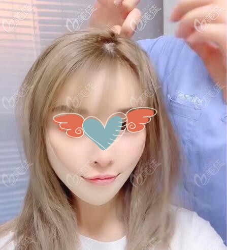 水剝離拉皮除皺真實案例效果 水剝離拉皮除皺真實案例效果