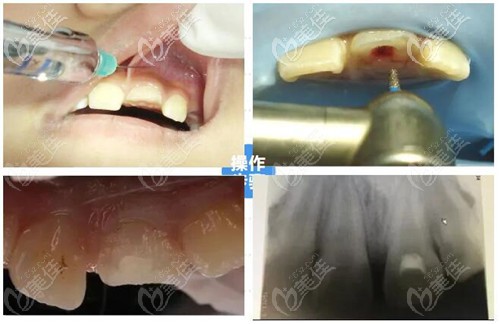 活髓切斷術(shù)治療過程 活髓切斷術(shù)治療過程