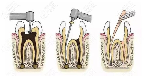 根管治療步驟過程 根管治療步驟過程