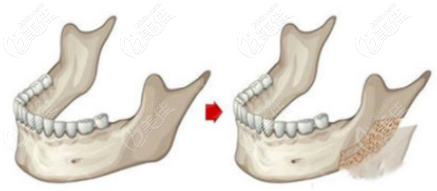 外板劈除手術(shù)部位