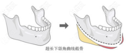 下頜角截骨手術(shù)部位