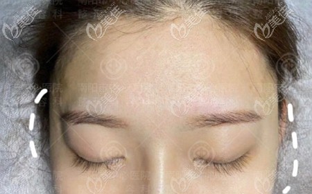 朋友們知道我用了2支潤百顏白紫中分子玻尿酸豐太陽穴后，都來問效果