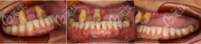 術前牙齒狀況 術前牙齒狀況