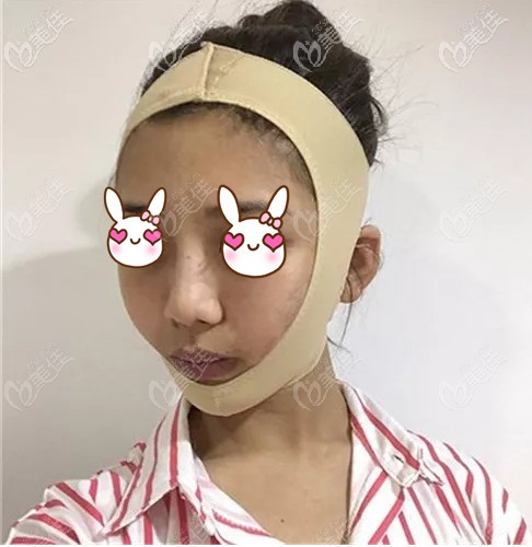 在承德美天做面部吸脂后戴面罩