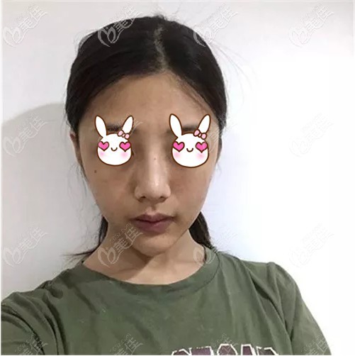 面部抽脂術(shù)后一個月恢復(fù)情況