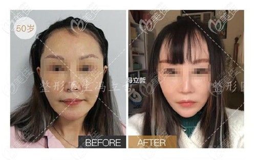 馮立哲面部除皺手術(shù)實例圖 馮立哲面部除皺手術(shù)實例圖