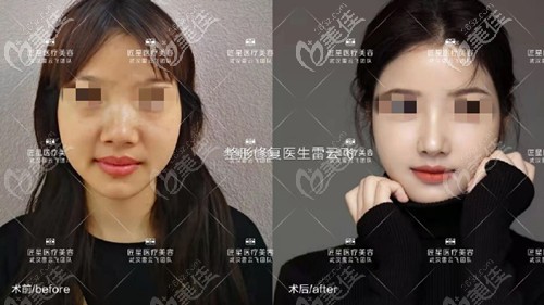 武漢匠星雷云飛鼻綜合案例