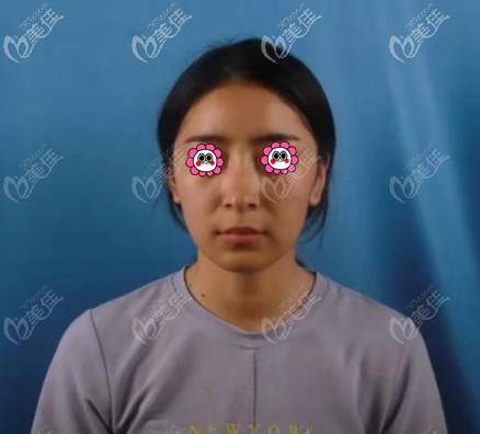 我做國產(chǎn)康寧硅膠假體隆鼻前 我做國產(chǎn)康寧硅膠假體隆鼻前