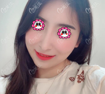 在北京童仁做國產(chǎn)康寧硅膠假體隆鼻2個多月 在北京童仁做國產(chǎn)康寧硅膠假體隆鼻2個多月