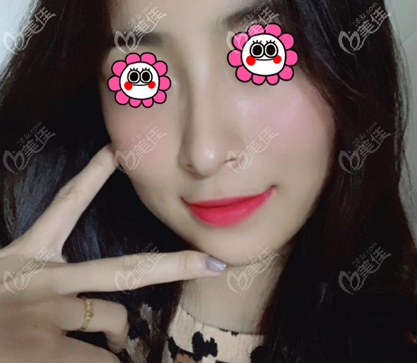 歐素嬌在哪家醫(yī)院?從我找她做的國(guó)產(chǎn)康寧硅膠假體隆鼻案例中便知