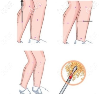 大腿吸脂手術(shù)