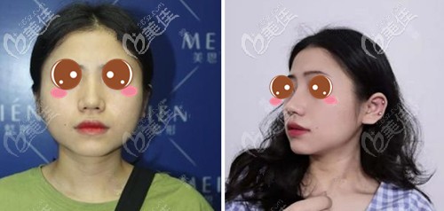 廣州美恩下頜角整形案例 廣州美恩下頜角整形案例