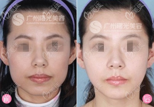 廣州曙光下頜角手術(shù)案例 廣州曙光下頜角手術(shù)案例