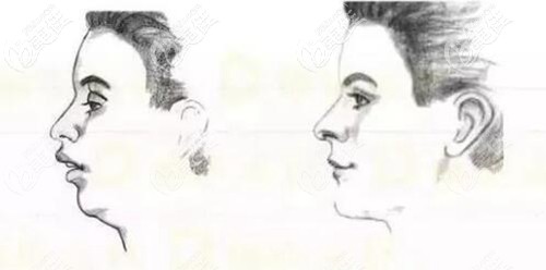 口呼吸導(dǎo)致的凸嘴做牙齒矯正改善了