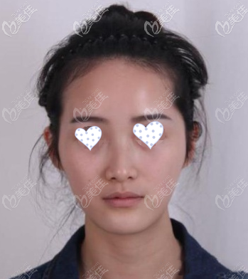 重度太陽穴凹陷 重度太陽穴凹陷