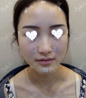 脂肪填充太陽穴凹陷3天照片 脂肪填充太陽穴凹陷3天照片