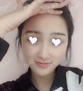 全臉脂肪填充10天照片 全臉脂肪填充10天照片