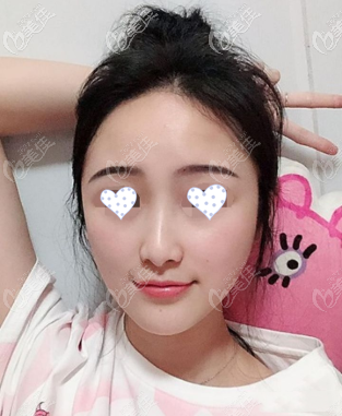 全臉脂肪填充30天照片 全臉脂肪填充30天照片