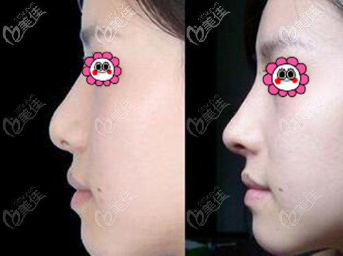 美國(guó)旭爾挺隆鼻案例