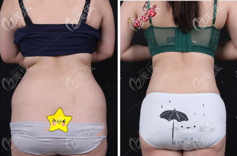 肚子吸脂3個(gè)月效果圖