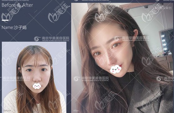 南京華美隆鼻案例