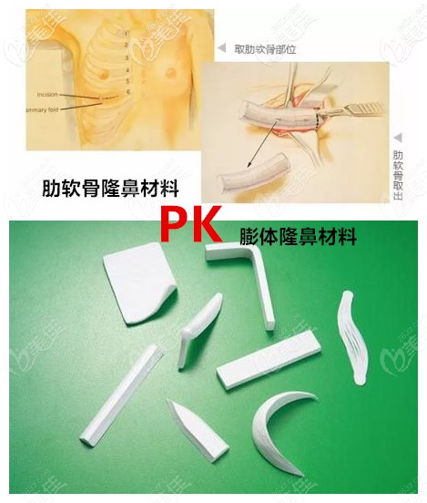 肋軟骨隆鼻和膨體隆鼻的對(duì)比