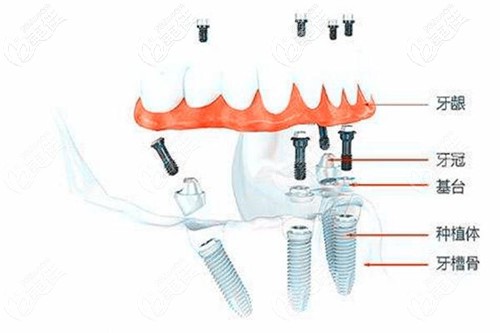 諾貝爾種植體的價格